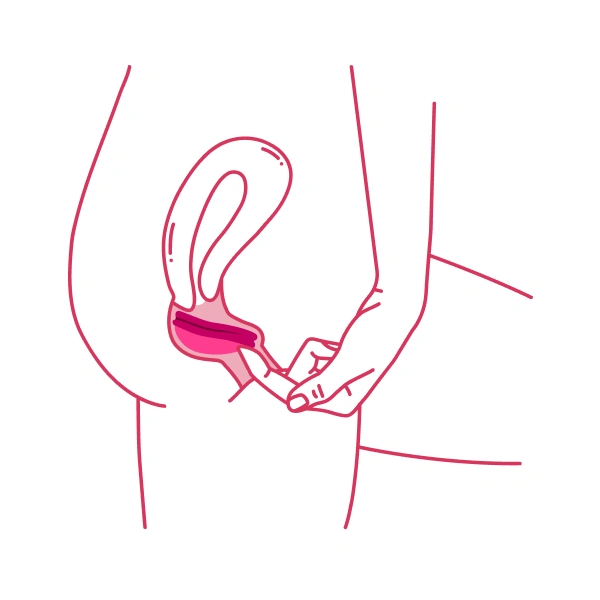Removal